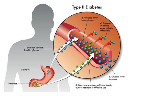 Diabetes Mellitus Sign And Symptoms Causes Diagnosis Complication