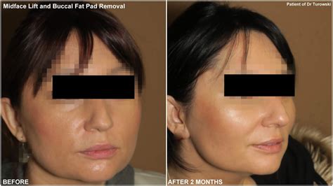 New Horizons Plastic Surgery Midface Lift And Buccal Fat Pad Removal