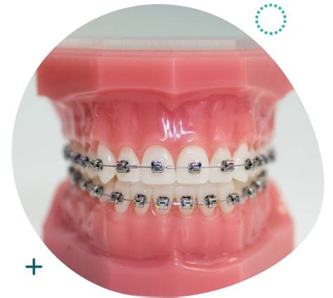 Damon Q Self Ligating Braces And Brackets Singapore