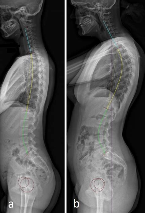 Sagittal X Rays Of Adolescents With Different Sagittal Curves A