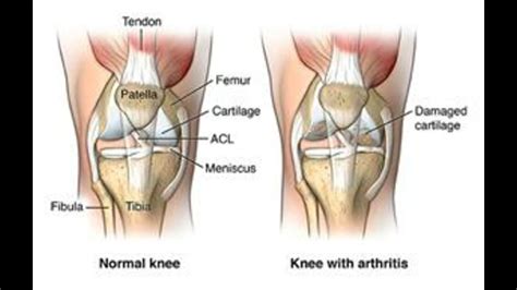 Arthroplasty CPT Codes Simplify Medical Coding YouTube