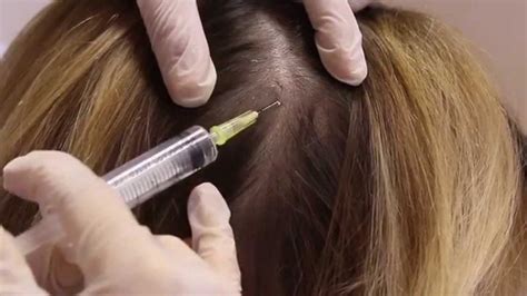 Mesotherapy For Hair Loss And Scalp Treatment Premier Clinic