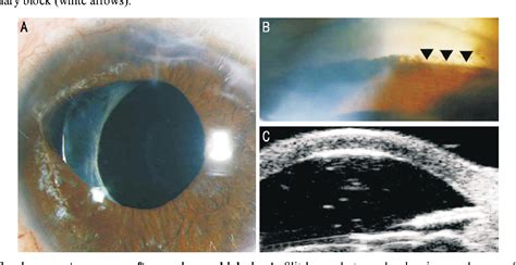 Goniosynechialysis For Secondary Angle Closure Glaucoma In A Pseudophakic Patient After