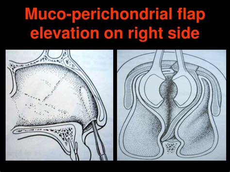 Ppt Deviated Nasal Septum Powerpoint Presentation Free Download Id