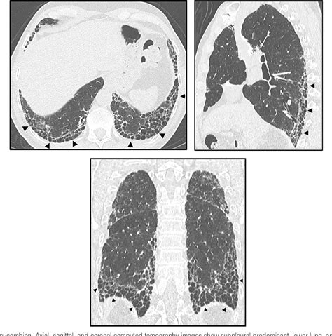 Figure 2 From Idiopathic Pulmonary Fibrosis An Update And Progressive