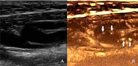 -The lymph node was noted during pre-CEUS ultrasound greyscale ...