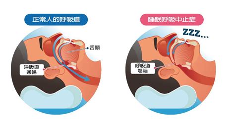 健保大數據／睡眠呼吸中止症有3種類型 診斷與治療方式一次看｜精神．身心｜醫療｜元氣網