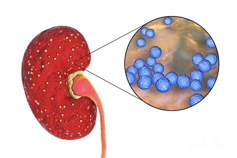 Acute Pyelonephritis Caused By Enterococcus By Kateryna Kon Science