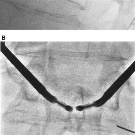 A Fluoroscopy Lateral View Illustrates The Bilateral Trocar Access