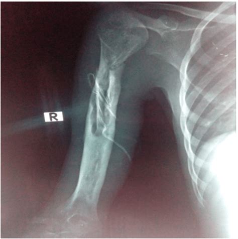 Ap View X Ray Of The Right Humerus Show The Sequestrum And Invulcurum