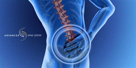 Lumbar Revision Surgery Frisco Tx Advanced Spine Center