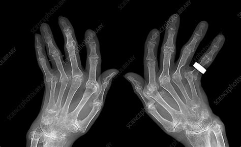 Rheumatoid arthritis, X-ray - Stock Image - C054/0311 - Science Photo ...