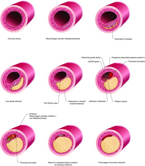 Coronary Artery Disease Pathophysiology - Captions Quotes
