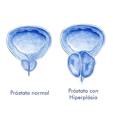 Hiperplasia benigna de Próstata HBP HC Marbella HC Marbella