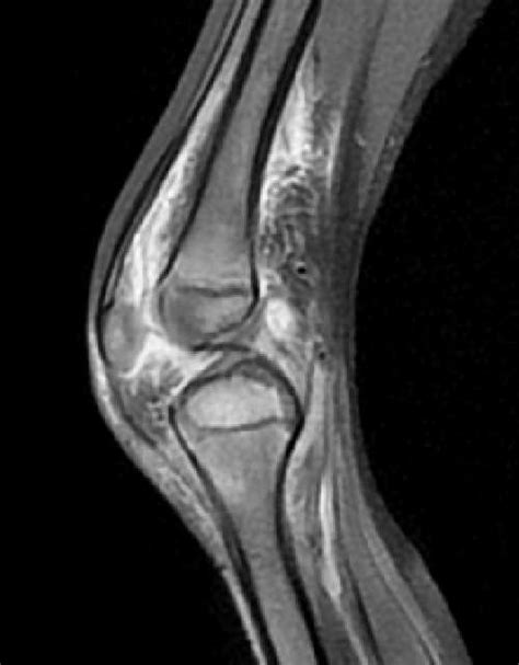 Septic Arthritis Of The Knee Pediatric Image Radiopaedia Org