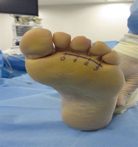 Plantar Approach For Excision Of A Morton Neuroma A Long Te JBJS