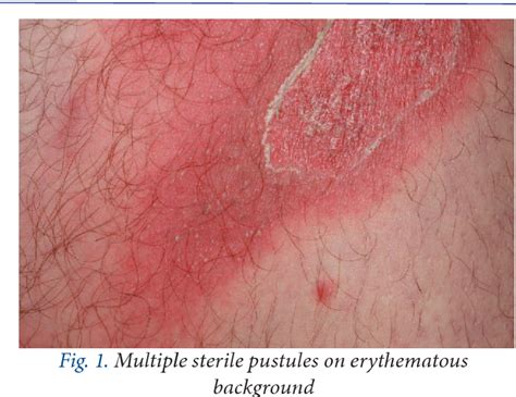 Acute Generalized Exanthematous Pustulosis Agep A Literature Review