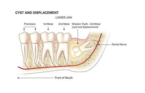 Dental Cysts management by dentist in Kingston, London