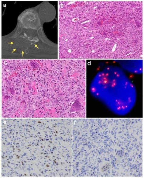 Figure From Giant Cell Rich Osteosarcoma Gcro Of The Spine On T