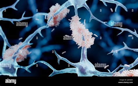 Amyloid plaque formation, illustration Stock Photo - Alamy