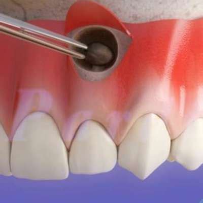 Apicoectomy 101: A Comprehensive Overview | Dr. Michael Koumas, DDS PC.