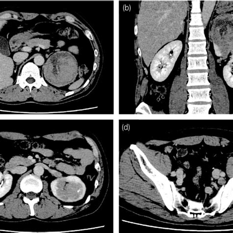 CT imaging findings before nephrectomy. (a) Abdominal enhanced CT ...