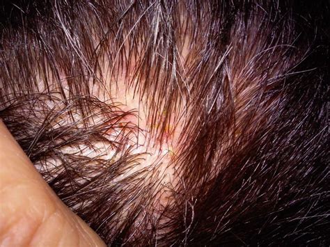 Scalp Folliculitis Pictures Pictures Photos - vrogue.co