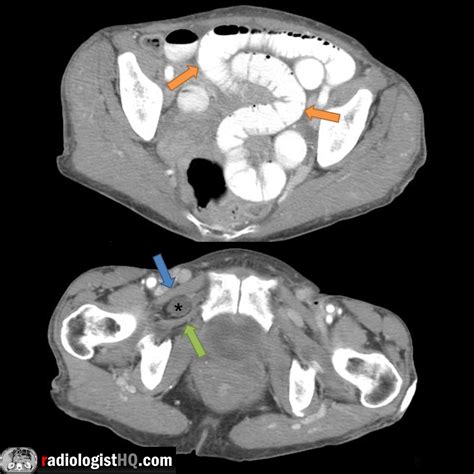 Ct Of Small Bowel Obstruction Caused By Obturator Hernia R Radiology