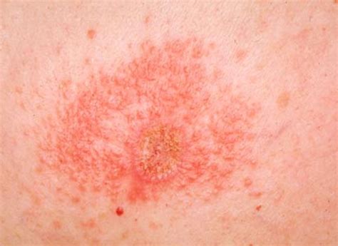 Contact Dermatitis Pictures Symptoms Causes Treatment Hubpages