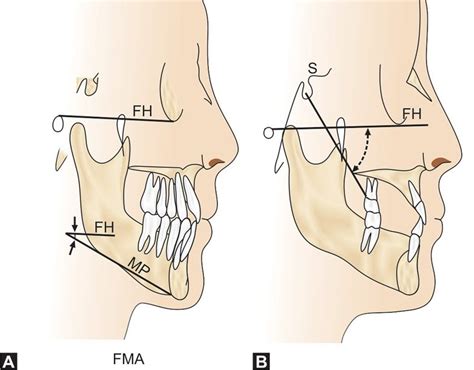 Frankfort Plane Dental Definition - DEFINITION HJO