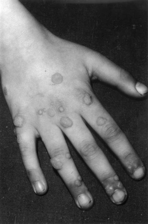 Causes Of Hand Warts