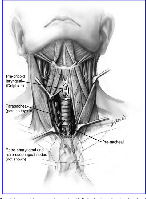 Paratracheal lymph node group | Semantic Scholar