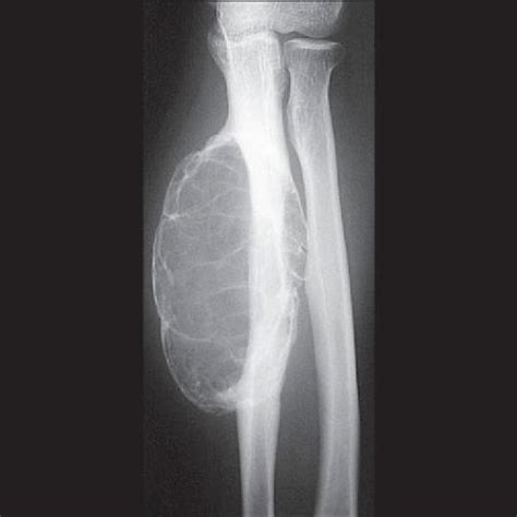 Multiloculated Bone Cyst Histology