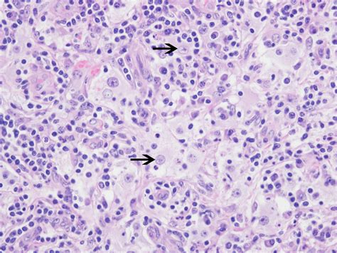 Pathology Outlines Rosai Dorfman Disease Rdd