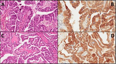 Representative Cases Of Intraductal Oncocytic Papillary Neoplasms