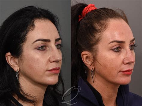 Rhinoplasty Before After Photos Patient 1001506 Serving Rochester