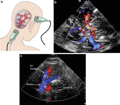 What Is Transcranial Doppler Ultrasound What Are Its Clinical