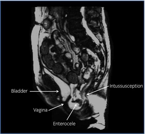 Preoperative Magnetic Resonance Defecography Download Scientific Diagram