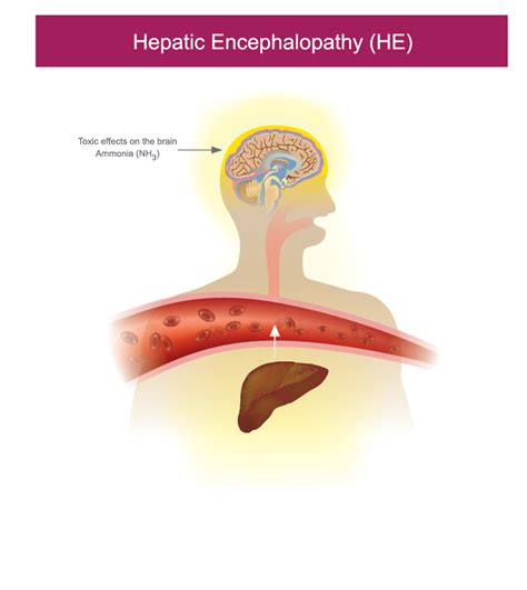 Hepatic Encephalopathy (HE) - British Liver Trust