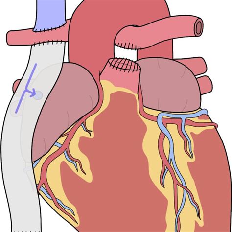 PDF Tricuspid Atresia Where Are We Now