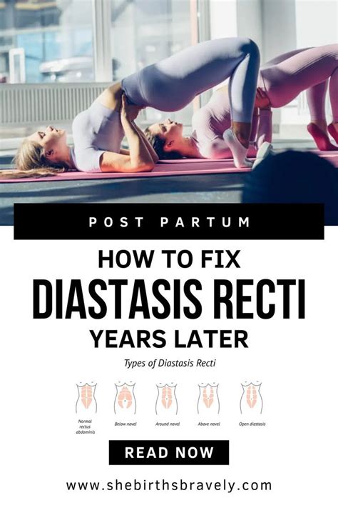 How To Fix Diastasis Recti Years Later Artofit