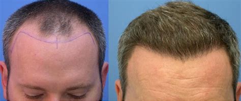 Best Hair Transplant Los Angeles Revive Hair Restoration Best Hair