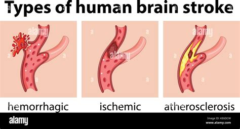 Tipos De Apoplej A Cerebral Humano Ilustraci N Imagen Vector De Stock