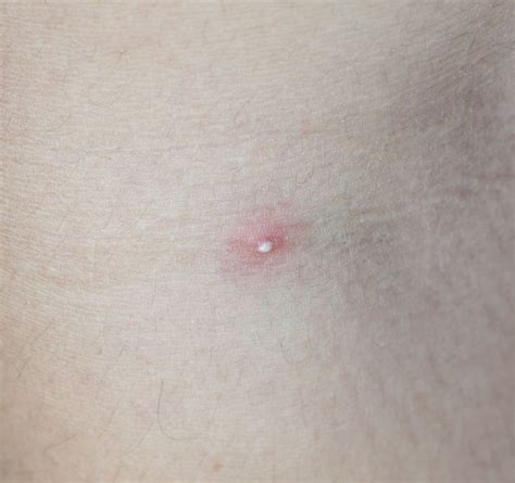 Pimples: Types, Causes, and Treatments