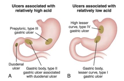 Peptic Ulcer Disease Flashcards Quizlet