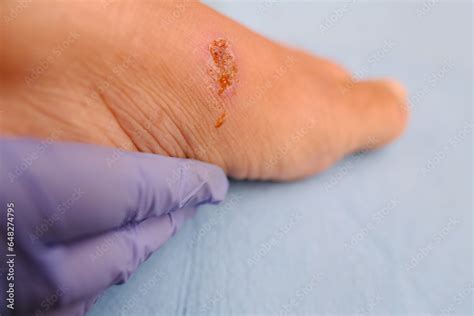 Doctor Treats Weeping Wound Trophic Ulcer On Female Leg Wound Exudate Prevents Healing Ulcers