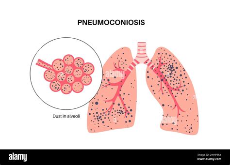 Pneumoconiosis Lung Disease Illustration Stock Photo Alamy