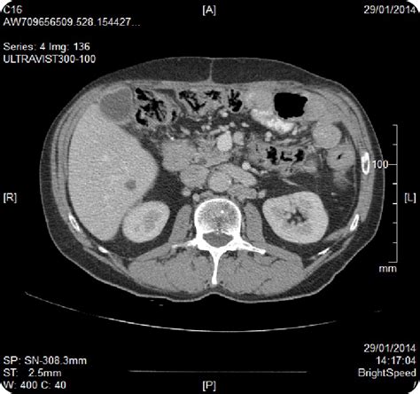 Metastases In The Retroperitoneal Lymph Nodes Download Scientific Diagram