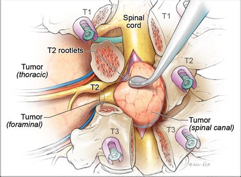 Combined Retropleural Thoracotomy And Posterior Spinal Approach For