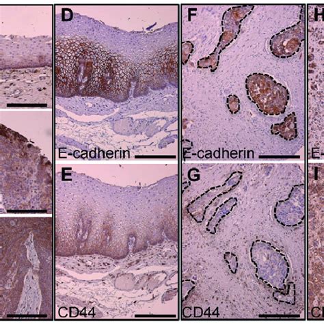 Inverse Correlation Of E Cadherin And Cd44 Expression In Primary Human Download Scientific